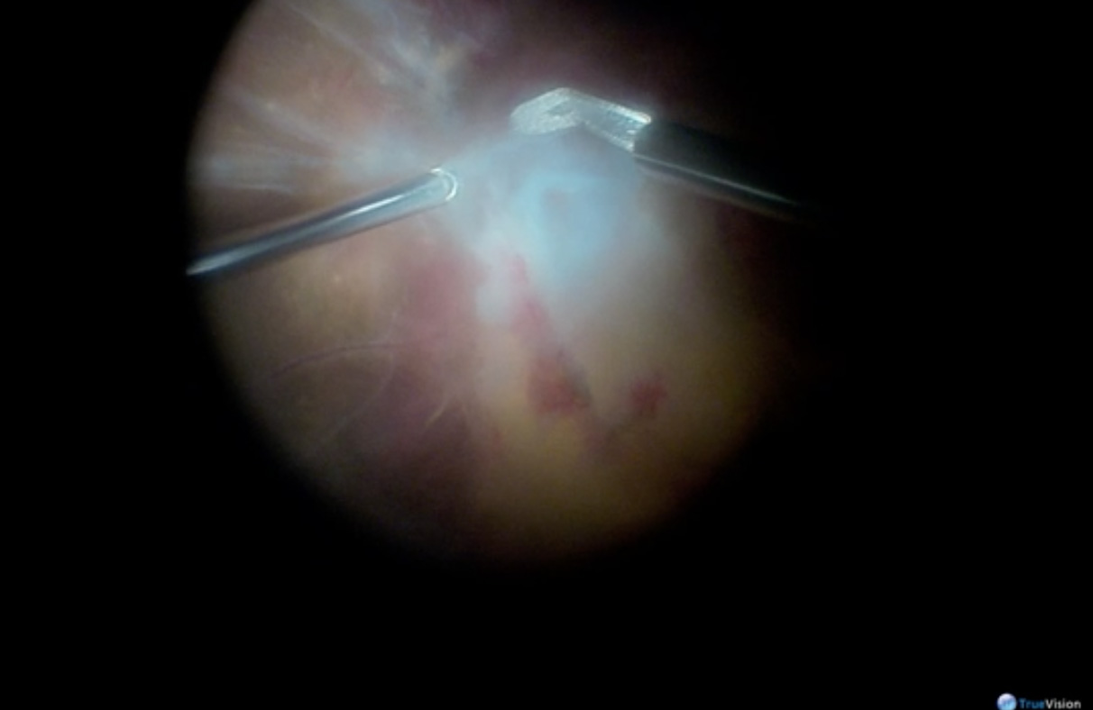 Heads-up 3-D Vitrectomy for Diabetic TRD [in 3-D]