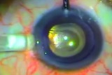 DSAEK Surgery with Endoshield Injector through 3.2 mm Clear Corneal Incision