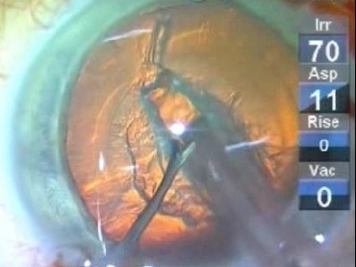 Routine Cataract Surgery with Dr. Tjia