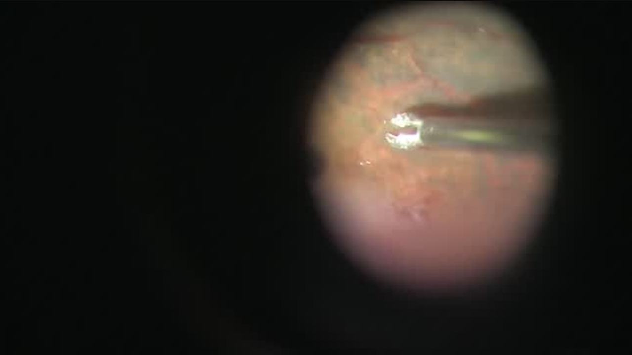 Complicated Retinal Detachment Surgery In An Eye With Cloudy Cornea [FLOREtina Live Surgery]