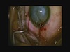 Hypermature, White Cataract Phacoemulsification