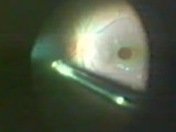 Management of Traumatic Macular Hole