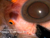 Giant Retinal Tear Using Chandelier and Perfluorocarbon Liquid
