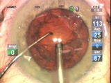 Cataract Surgery with Ike Ahmed, MD