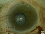 Preplaced Inferior Suture for Sphincterotomy