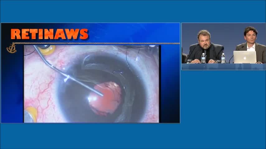 Sympathetic Ophthalmia