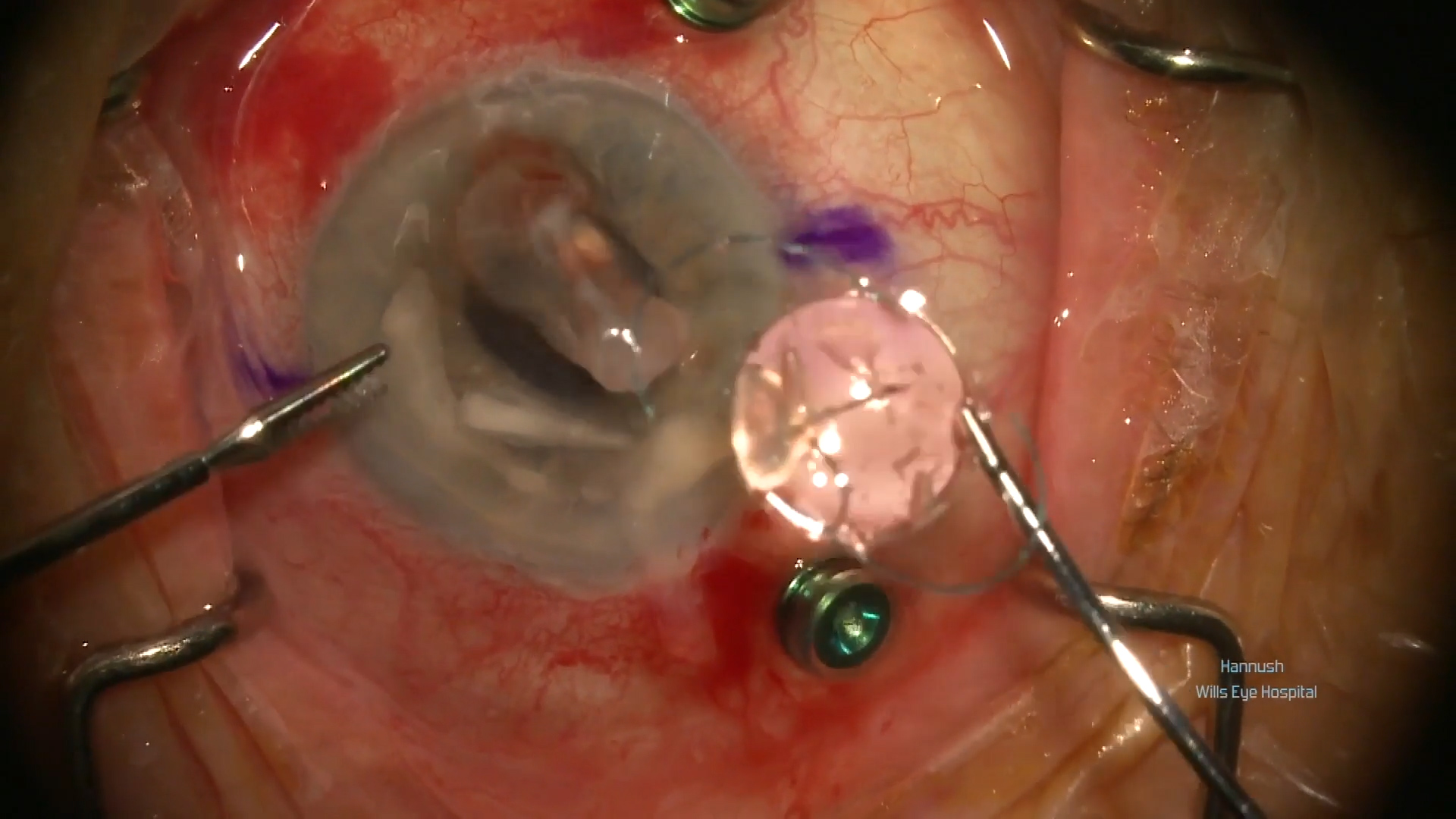 Addressing Endothelial Decompensation and Pseudophacodonesis 