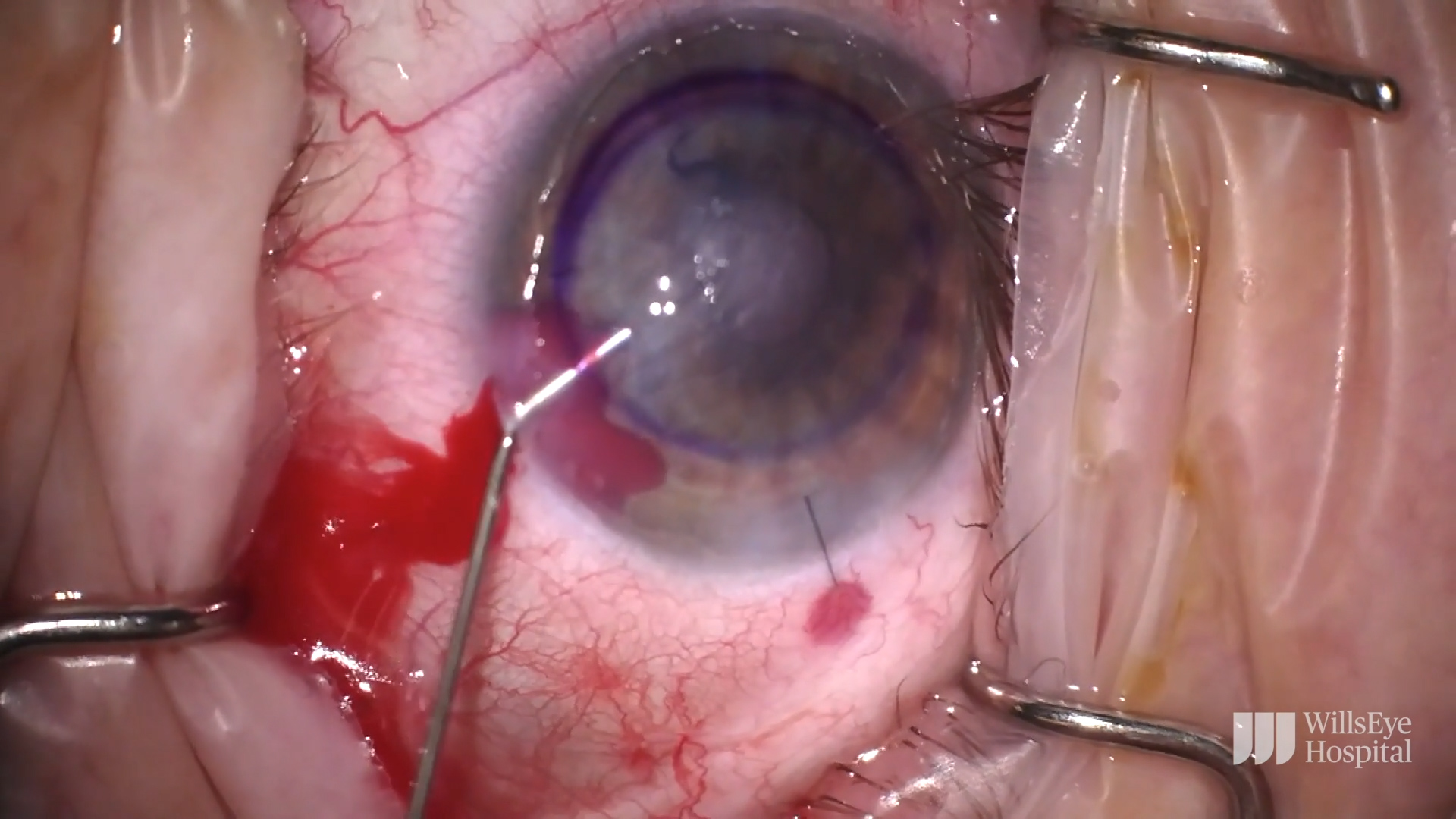 DMEK Triple Procedure With a Twist