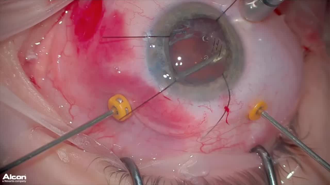 Traumatic Cataract