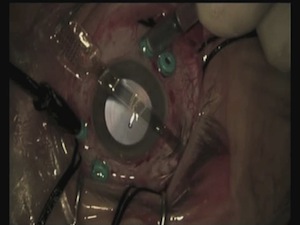 ARGUS 2 Retinal Implant