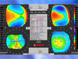 Toric Multifocal IOL: Most Complete Phaco Refractive Surgery
