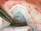 Non-Penetrating iCath Canaloplasty