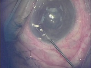 Removal of Ozurdex from Anterior Chamber of Pseudophakic Patient