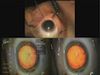 Endocoat Technique