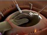 Tan EndoGlide for use in DSAEK Surgery