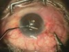 Scleral Fixation of PC IOL
