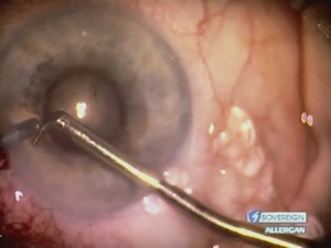 Blind Chopping in Small Pupil Case