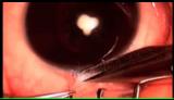 Pediatric cataract with 23G pars plana vitrectomy