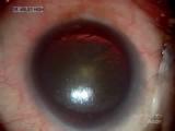 A Complete Cataract Surgery