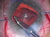 Surgical View Through the Lumera
