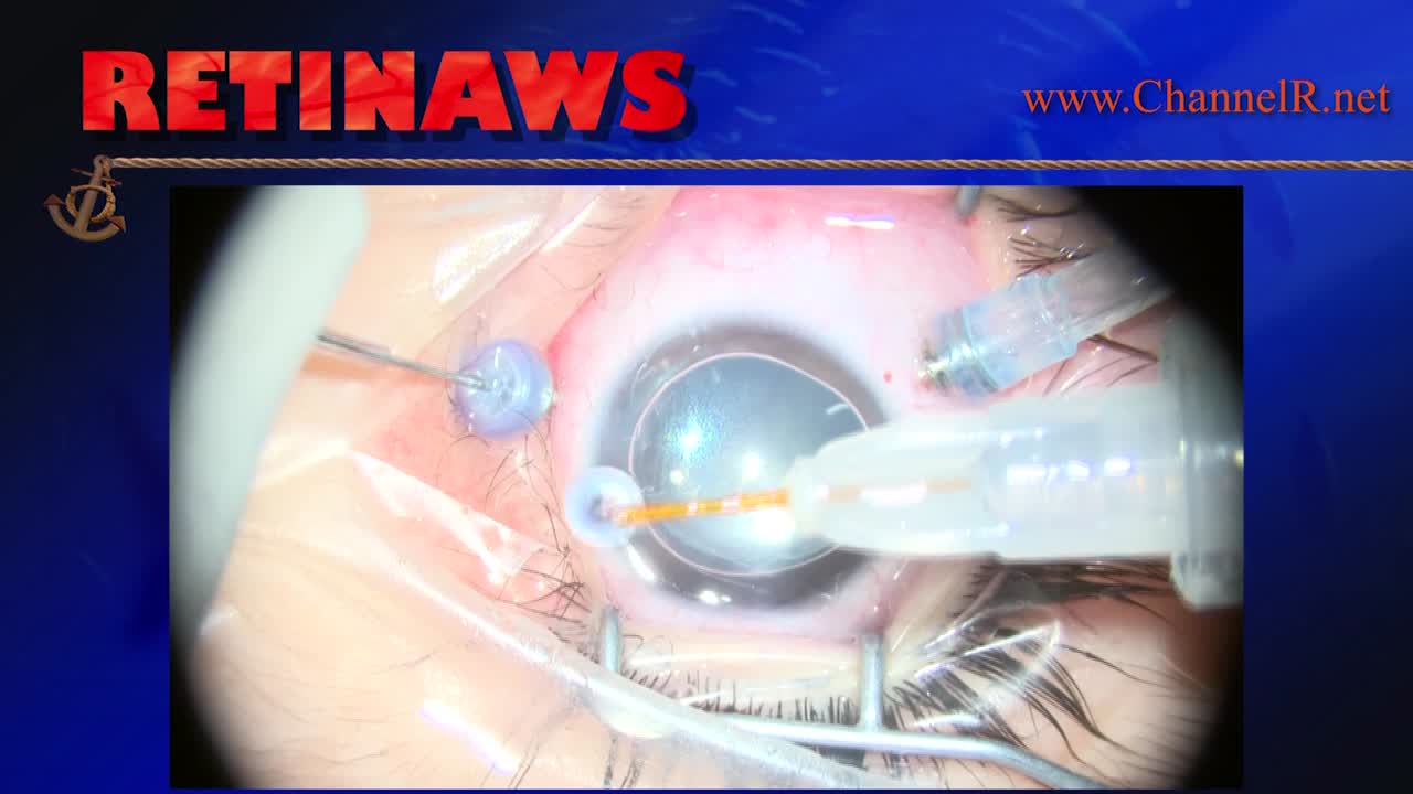 Macular Hole & RD