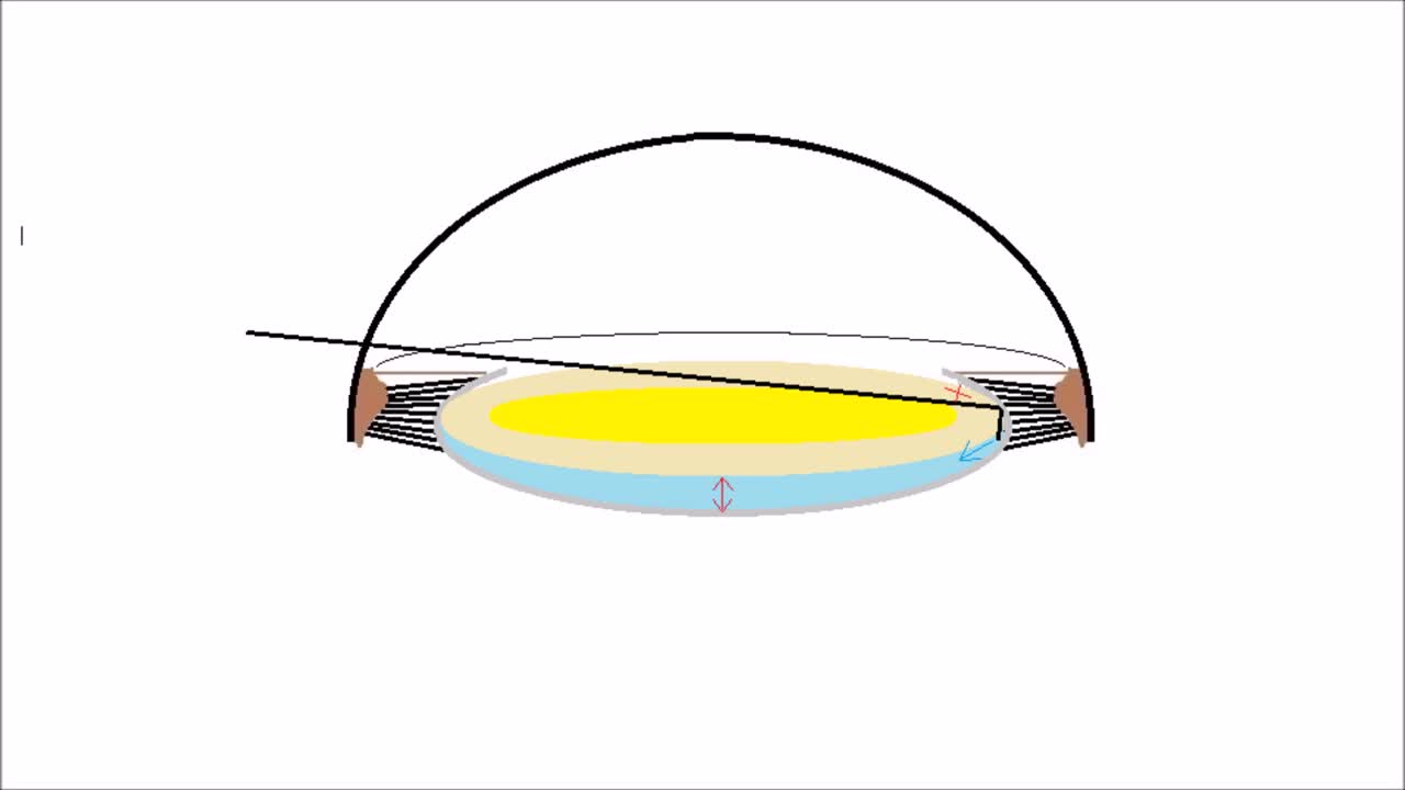 Capsular Fornix Hydrodissection: A Better Way to Hydrodissect