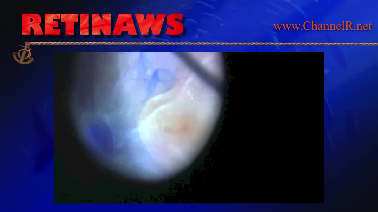Optic Nerve Pit