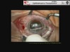 Femtosecond-Assisted Anterior Lamellar Keratoplasty