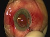 IOL Repositioning and Iris Repair