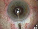 Astigmatic Keratotomy Incisions