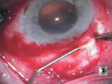 Intrascleral Posterior Chamber IOL Fixation