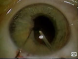Peripupillary Mebranectomy, Synechiolysis, Tissue Plasminogen Activator