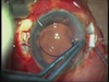 Live Surgery of Glued IOL