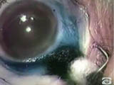 Phacoemulsification