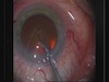 Double Cross-Action Capsulorhexis Forceps