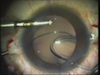Handshake Technique and Anterior Chamber Maintainer in Multifocal Glued IOL