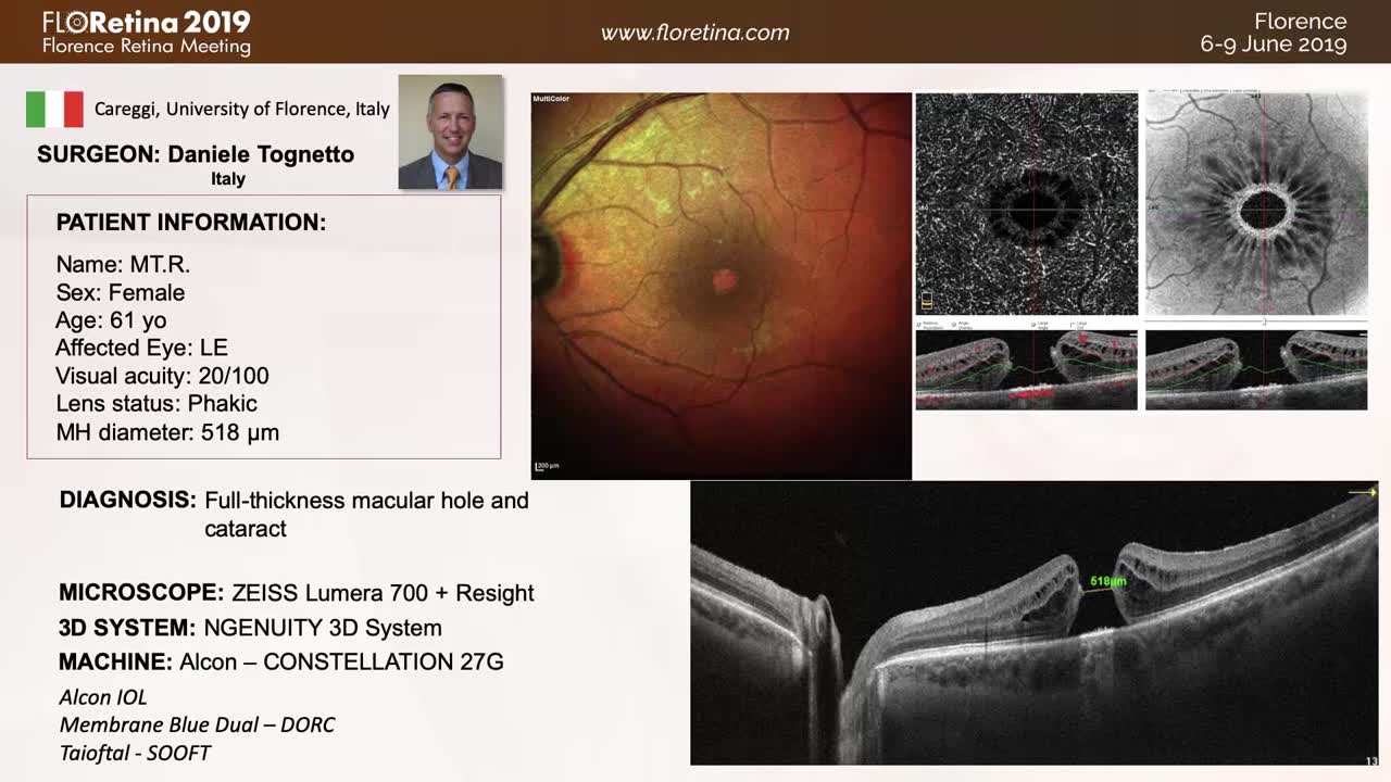 [3D] Combined Surgery in an Eye With Large Macular Hole