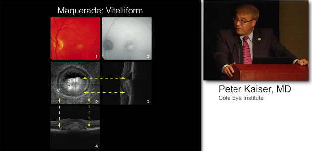 Differentiating Masquerade Syndromes with OCT-A