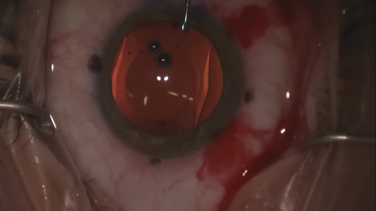 Toric ICL Placement