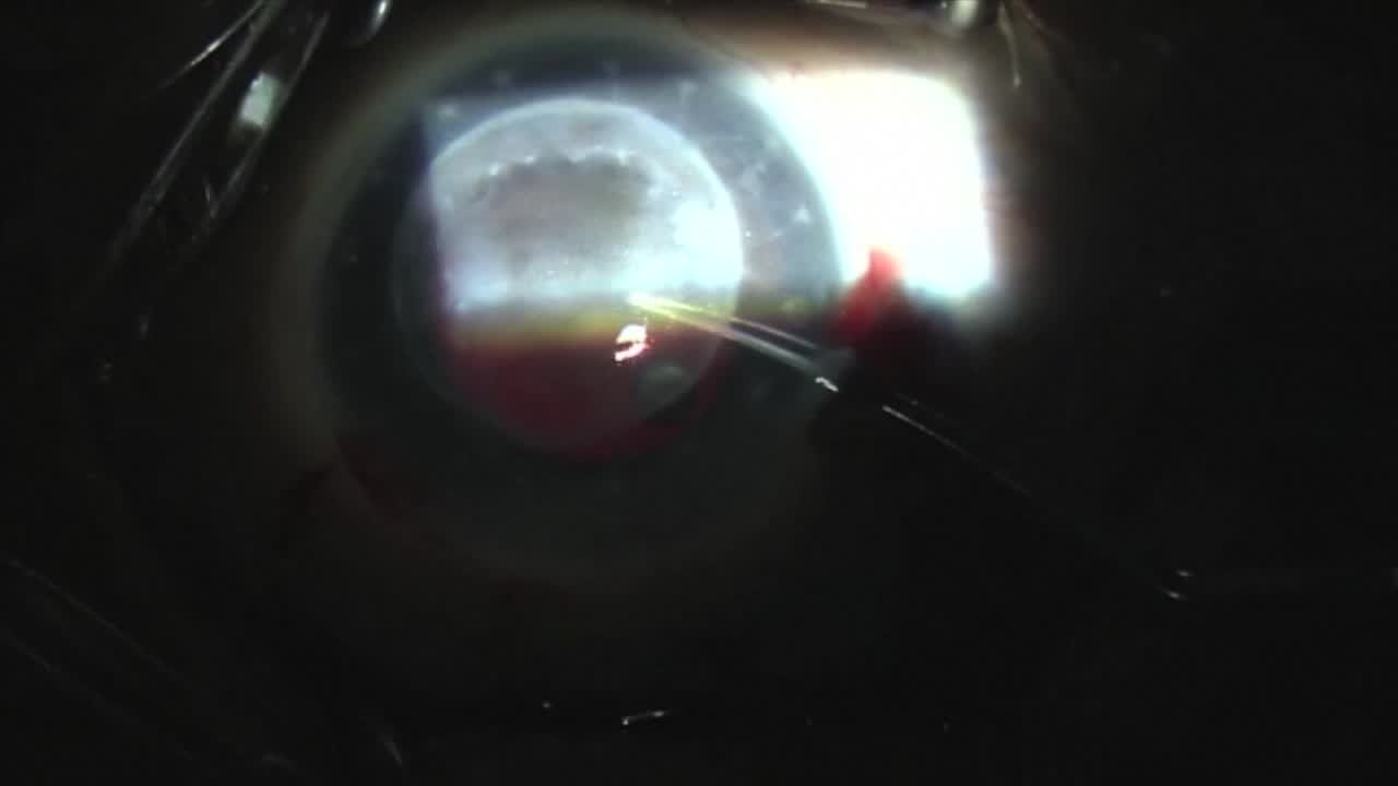 How Cloudy Can a Cornea Get?