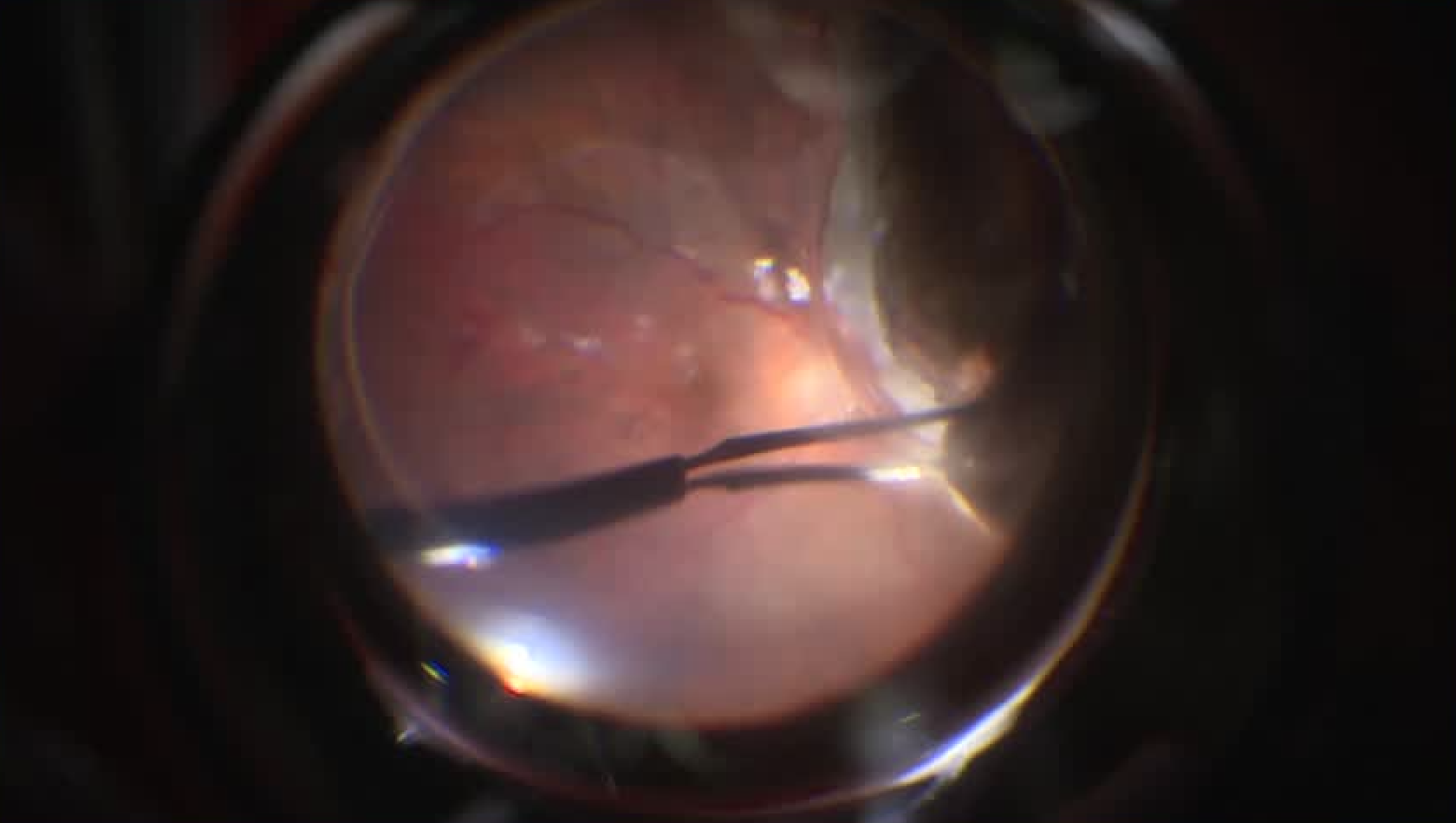 Suprachoroidal Oil