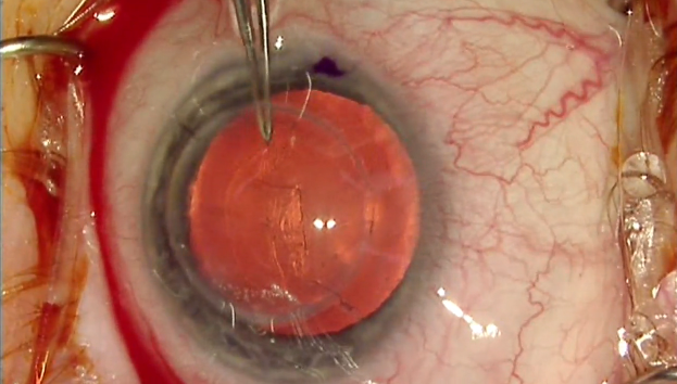 Severe Endophthalmitis
