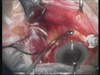 Choroidal Hemorrhage After SRF Drainage