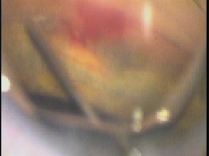 Endoscopic iStent Placement with ECP