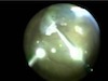 Timely Lens Dislocation