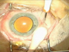 Retinal Biopsy