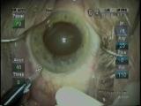 Using Discovisc in an IFIS Eye