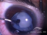 Congenital Iris Coloboma and White Cataract