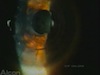 Endophthalmitis...