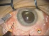 Trocar Induced Choroidal Detachment